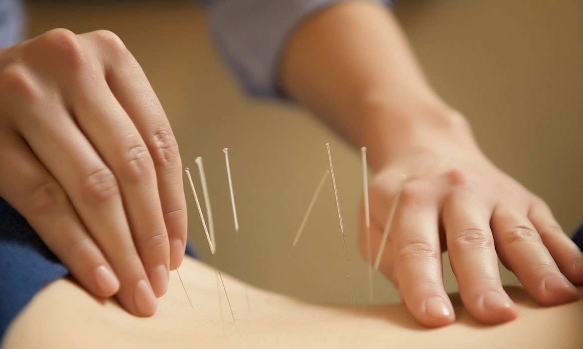 Acupuncture